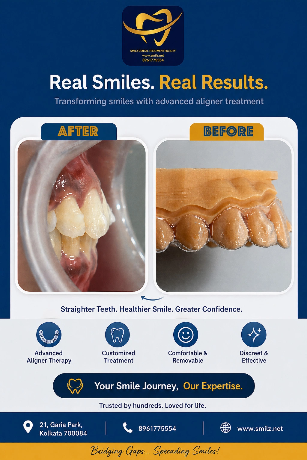 Clear Aligners at Smilz Dental Treatment Facility | Garia | Kolkata