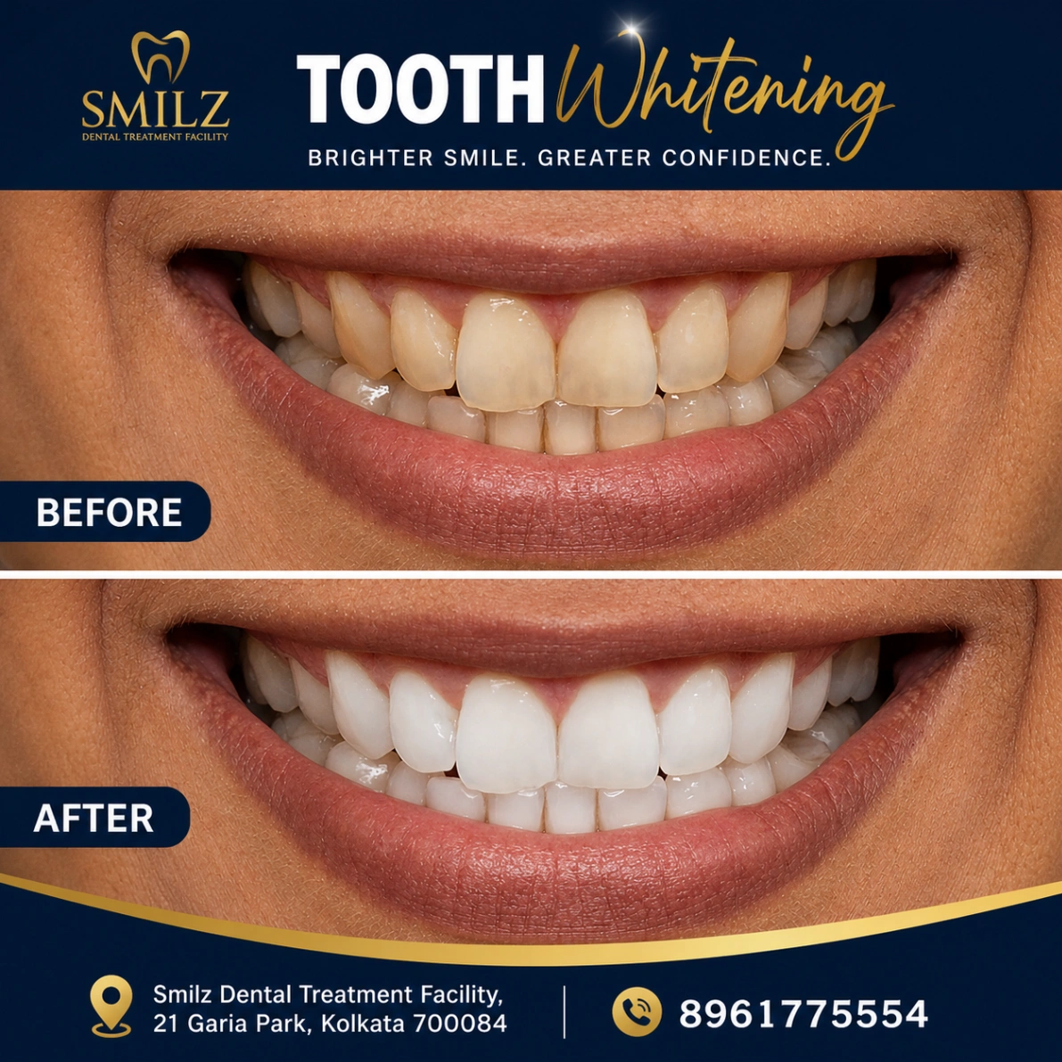 Tooth Whitening in Garia | Kolkata