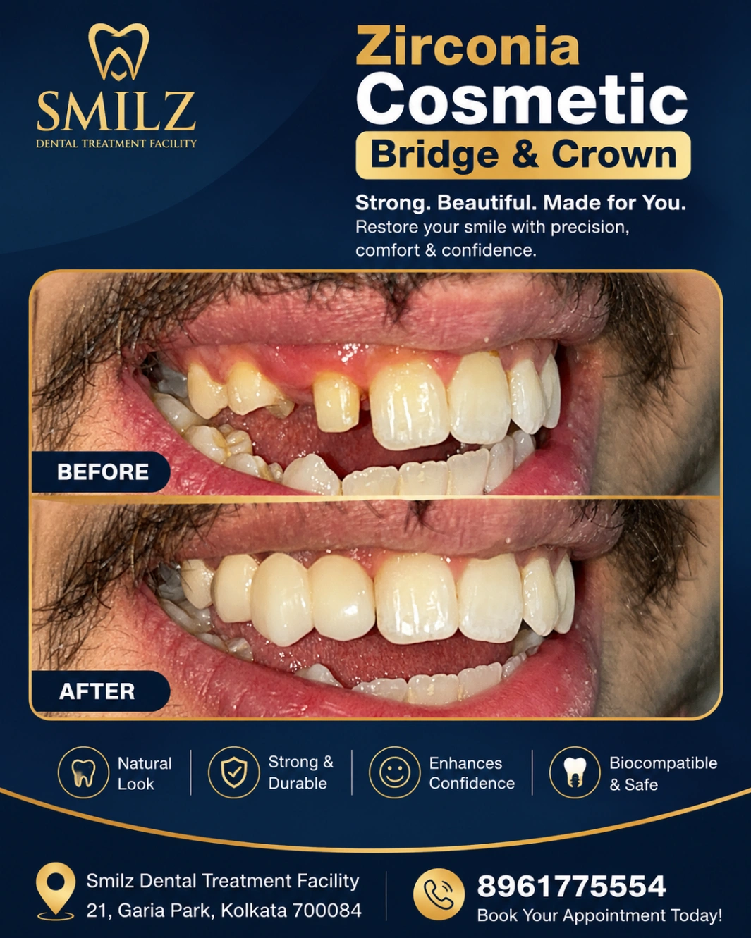 Zirconia Cosmetic Bridge Smilz Dental Garia Kolkata