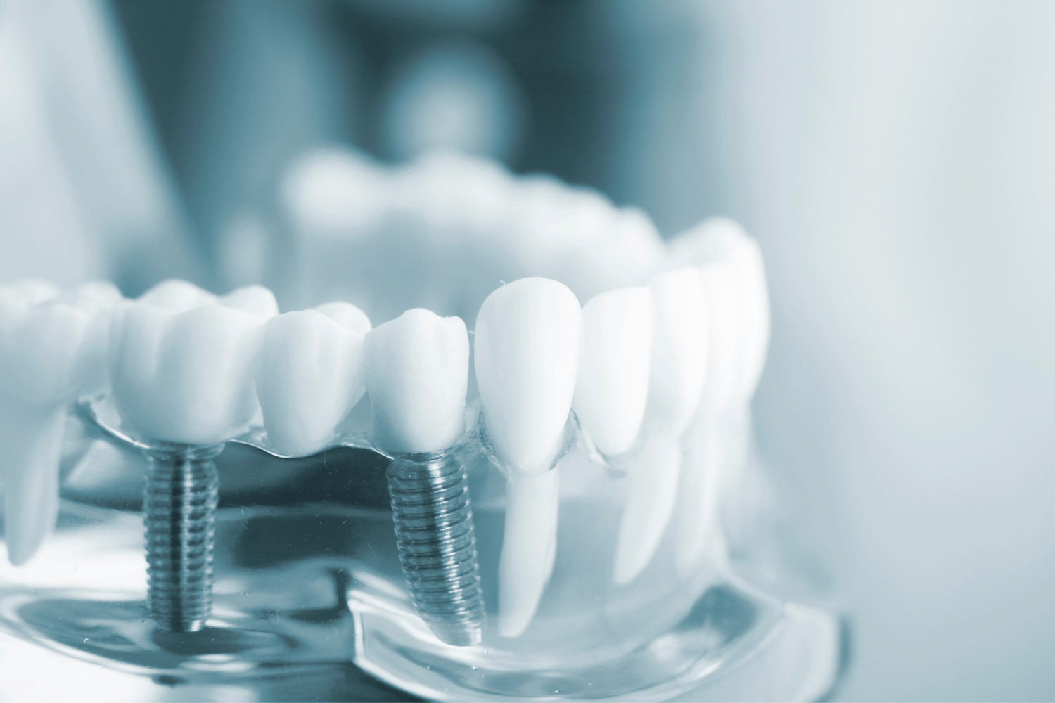 Dental Implants - Guided Approach