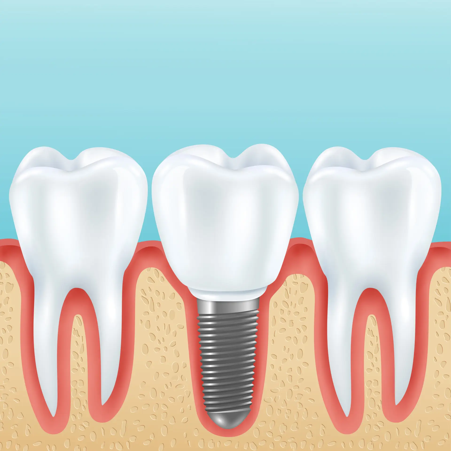 The Ultimate Guide to Dental Implants in Kolkata – Cost, Benefits & Procedure